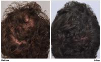 ForHair Hair Transplant Clinic image 3